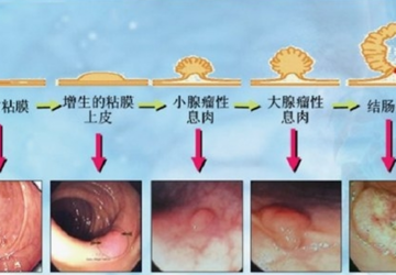 《结直肠癌的预防——早筛最重要》